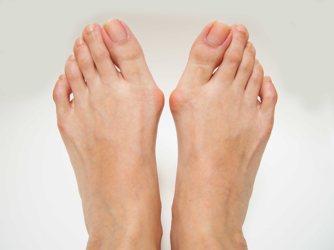 Bunions